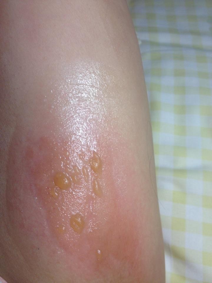 手被开水烫伤了怎么办