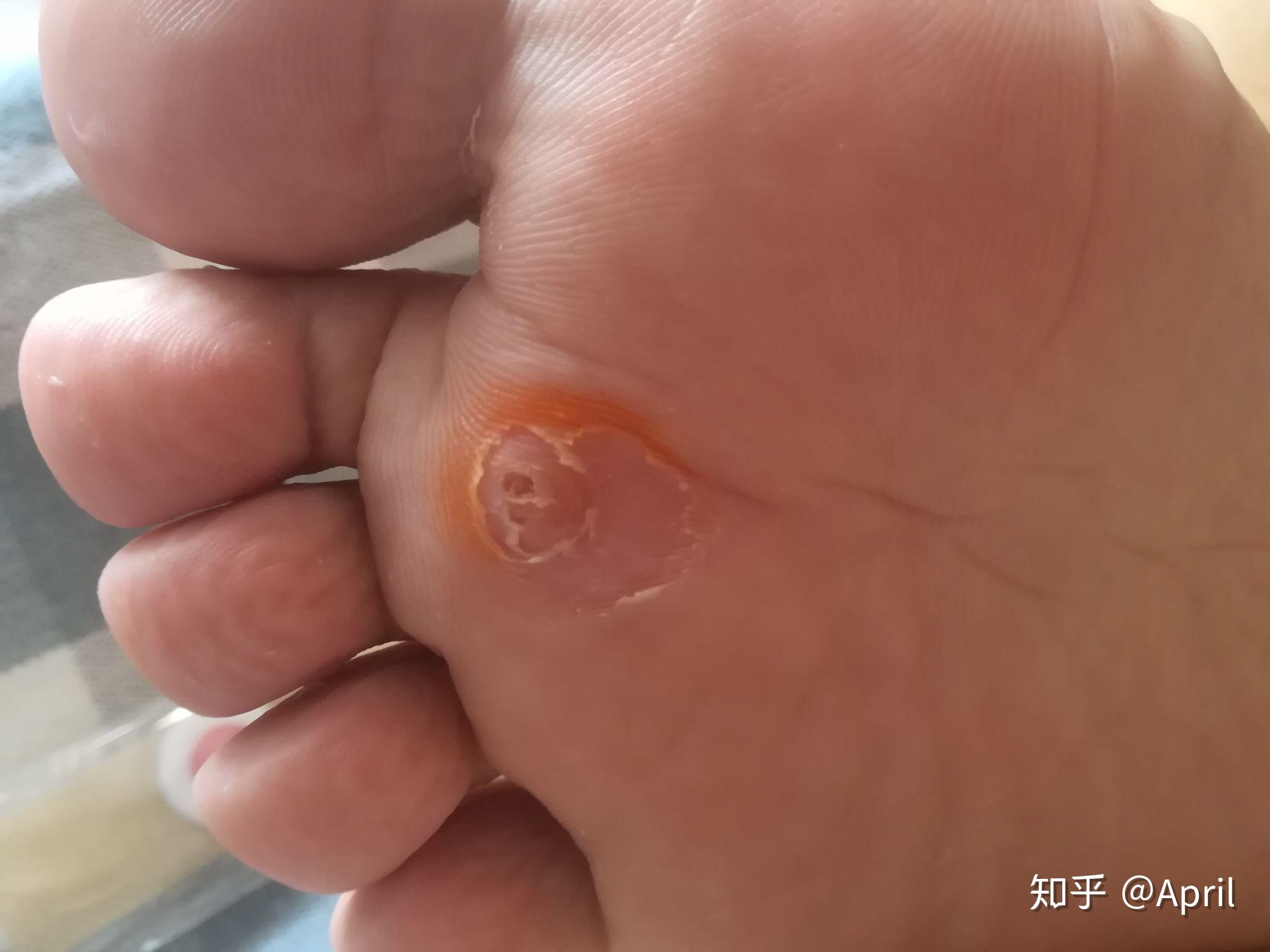 你是如何治好腳上長的雞眼的