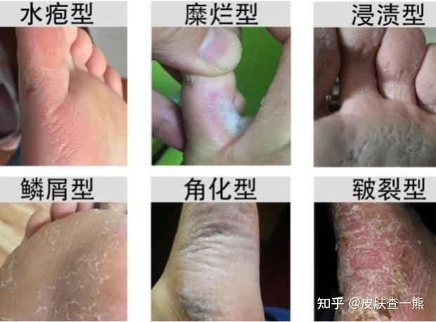 鱗屑角化型腳氣怎麼治