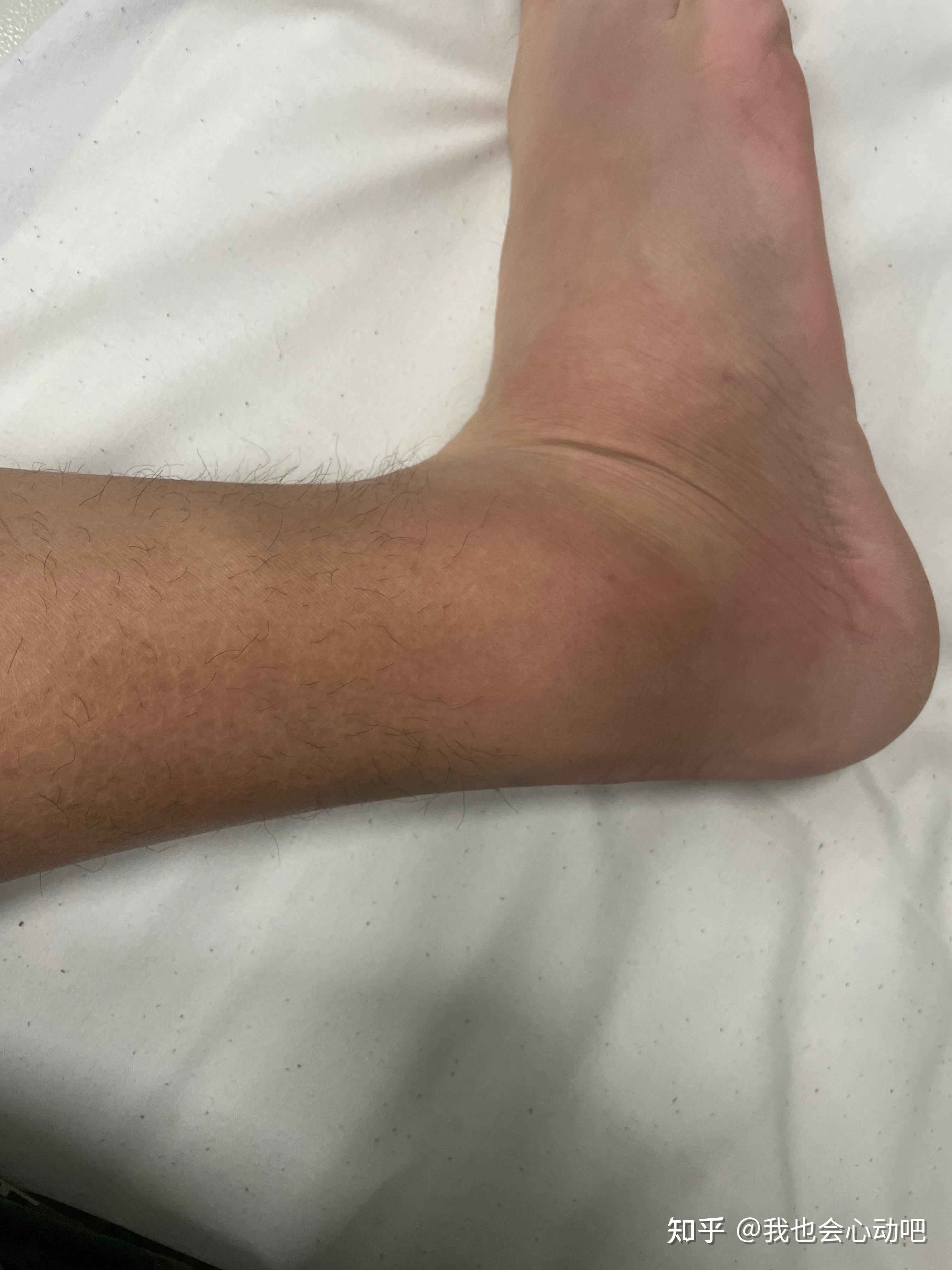 脚崴了肿了如果不及时处理会怎样