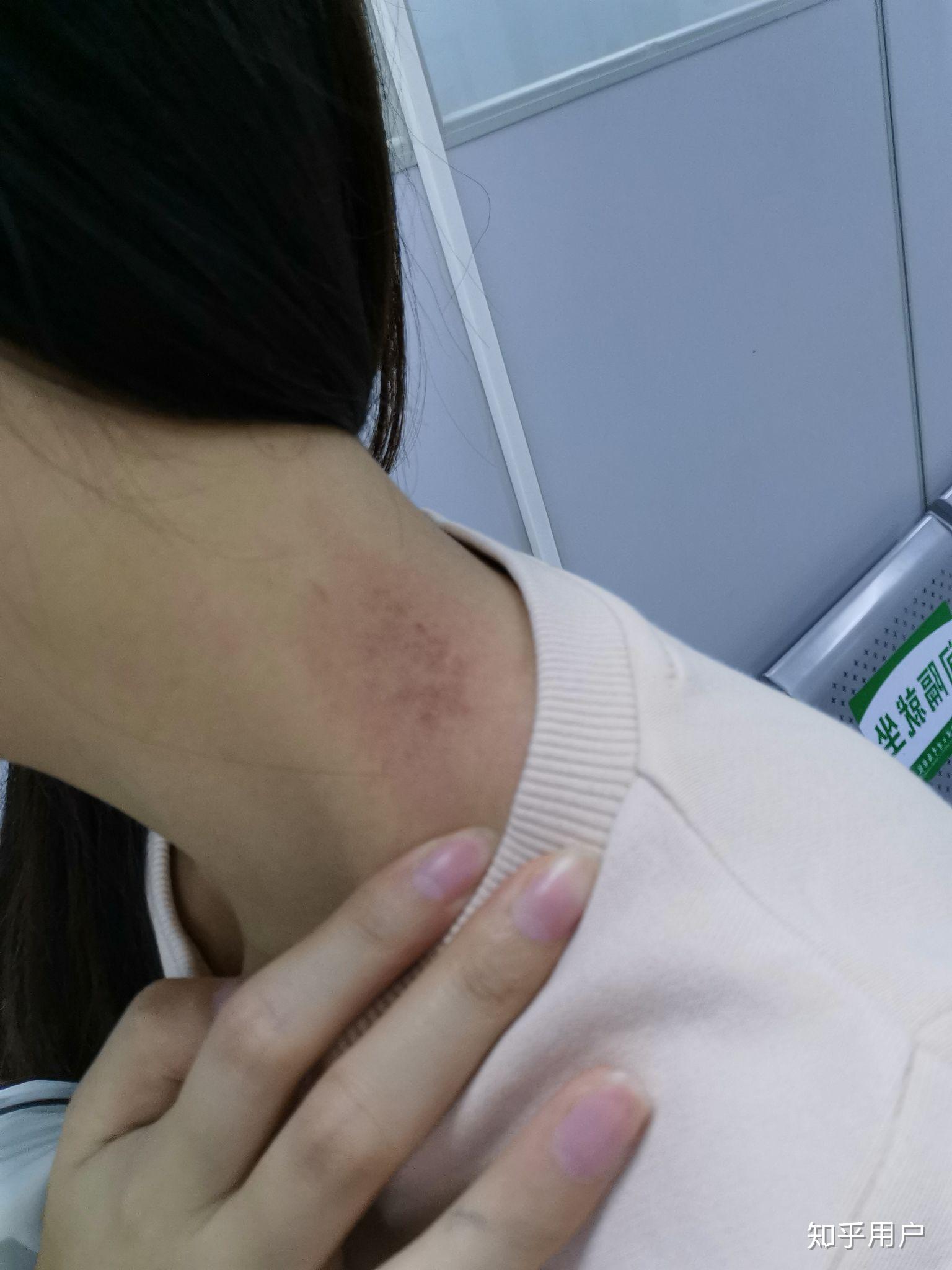 外阴白斑怎样治愈