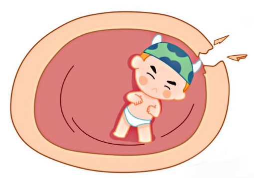 胎膜早破常见又危险,一旦发生,赶紧就医!