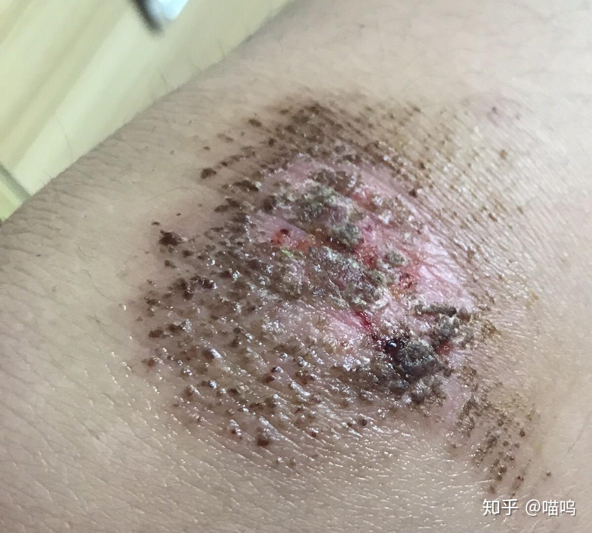 膝盖摔伤抹了碘伏结痂后如何防止留疤