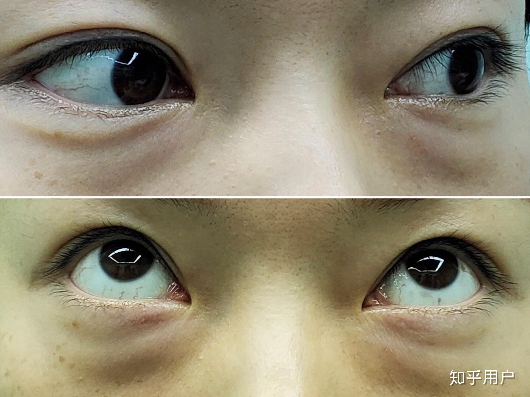 割眼袋是一种怎样的体验?