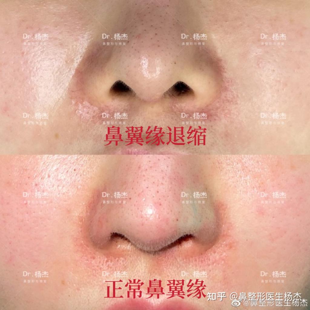 我的鼻翼缘退缩修复方法及微创理念 - 知乎