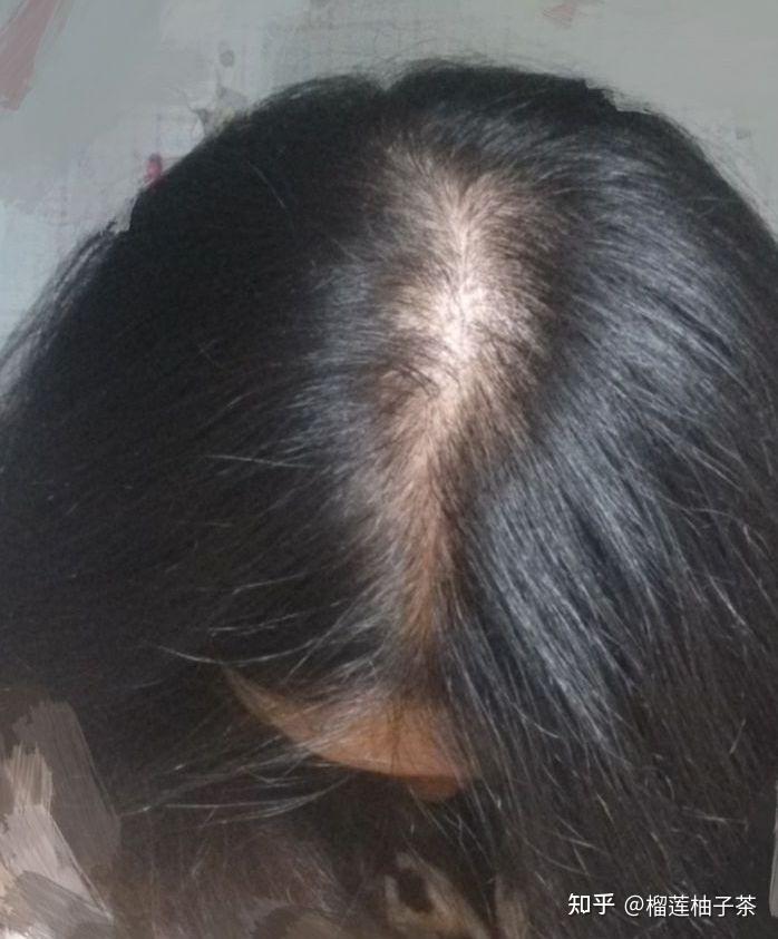 女生头发少怎样增加发量让头发变多? - 知乎