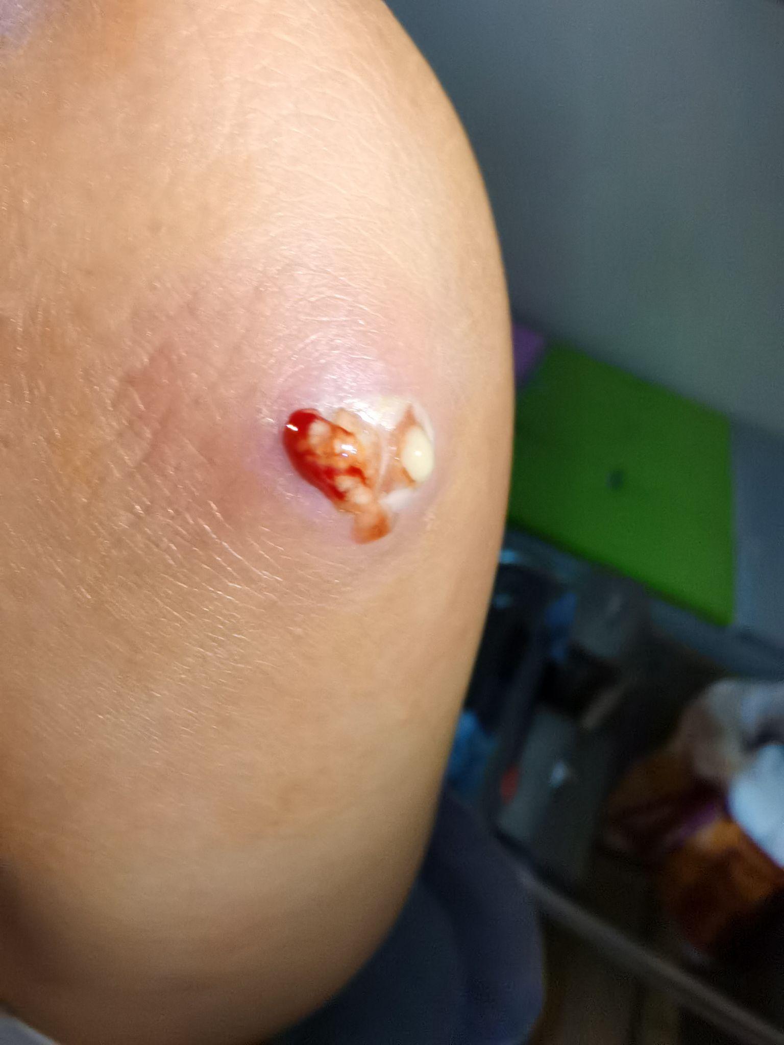 人体的火疖子 (化脓性毛囊及毛囊深部周围组织的感染) 能有多大?