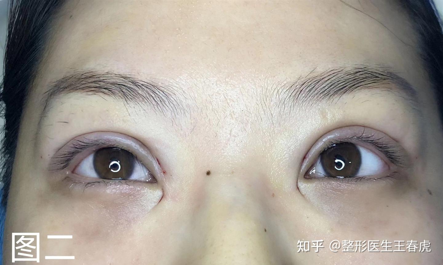 内双可不可以做双眼皮呢? - 知乎