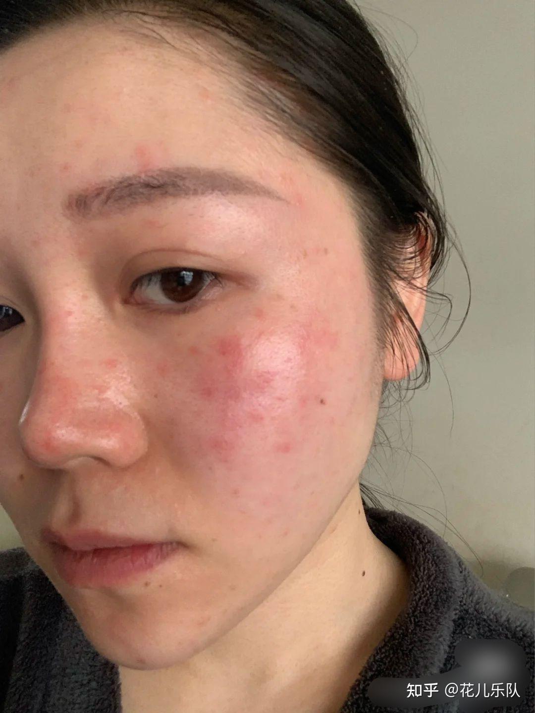 脸上有过敏性皮炎和湿疹该怎么办? - 知乎