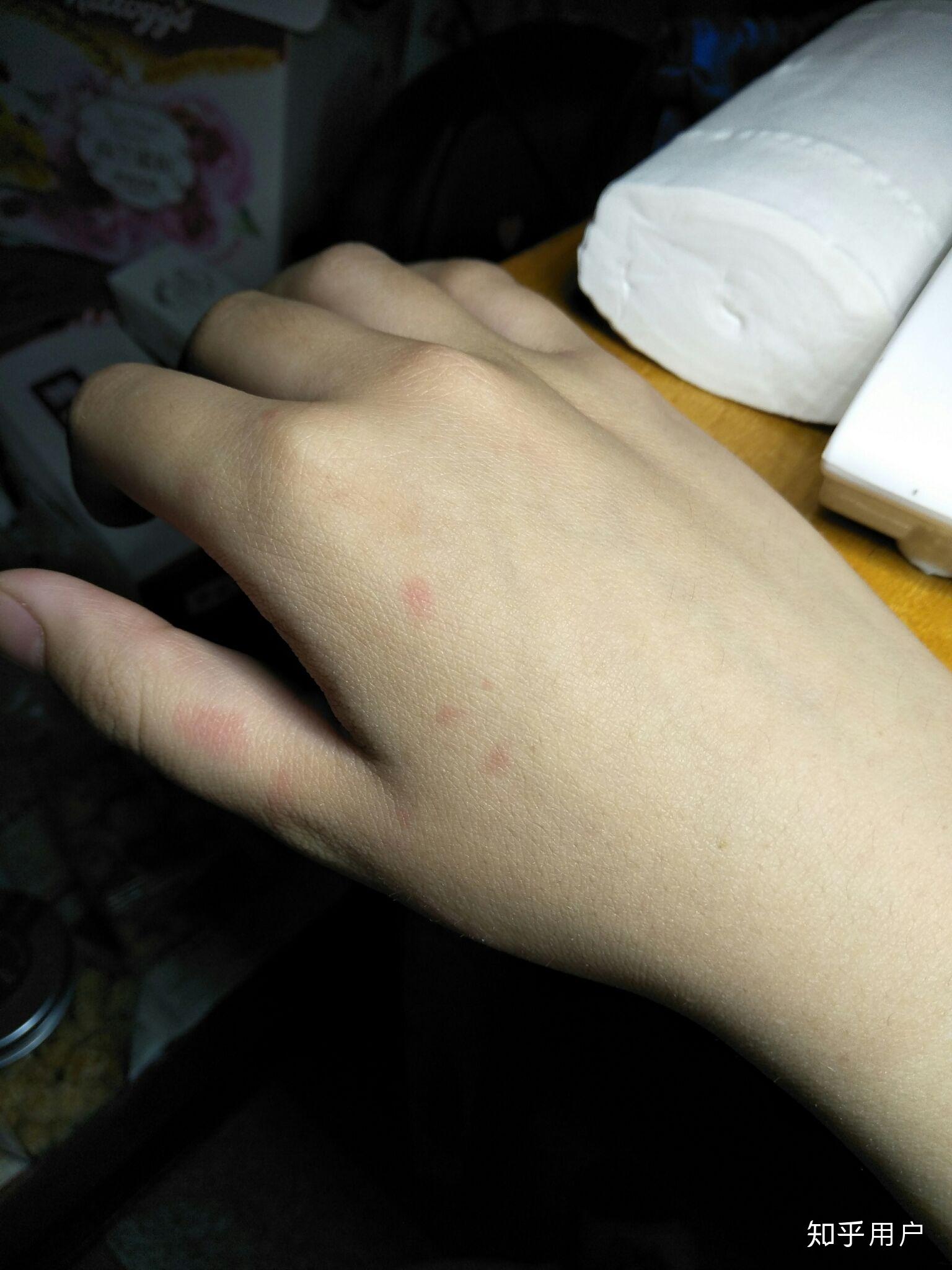 手上出现小片红斑,不痒? - 知乎