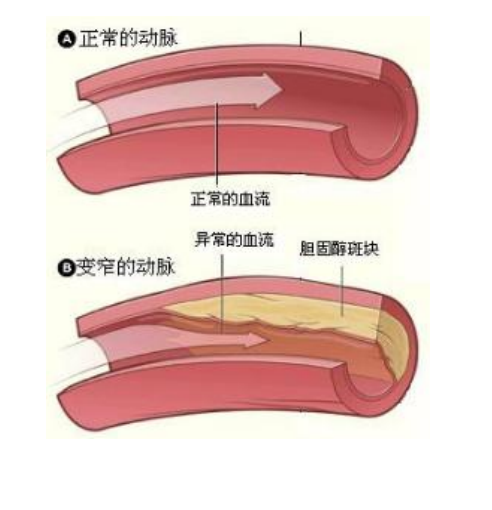 造成血管老化加速的坏习惯⑥ - 知乎