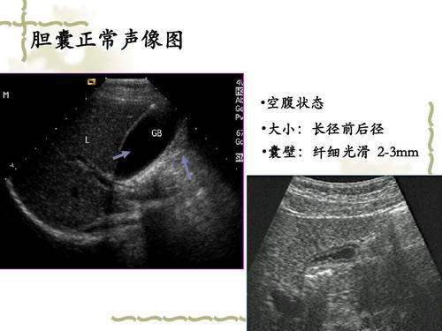 招飞体检腹部超声发现胆囊壁增厚会被淘汰吗