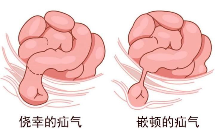 一个月婴儿疝气图片图片