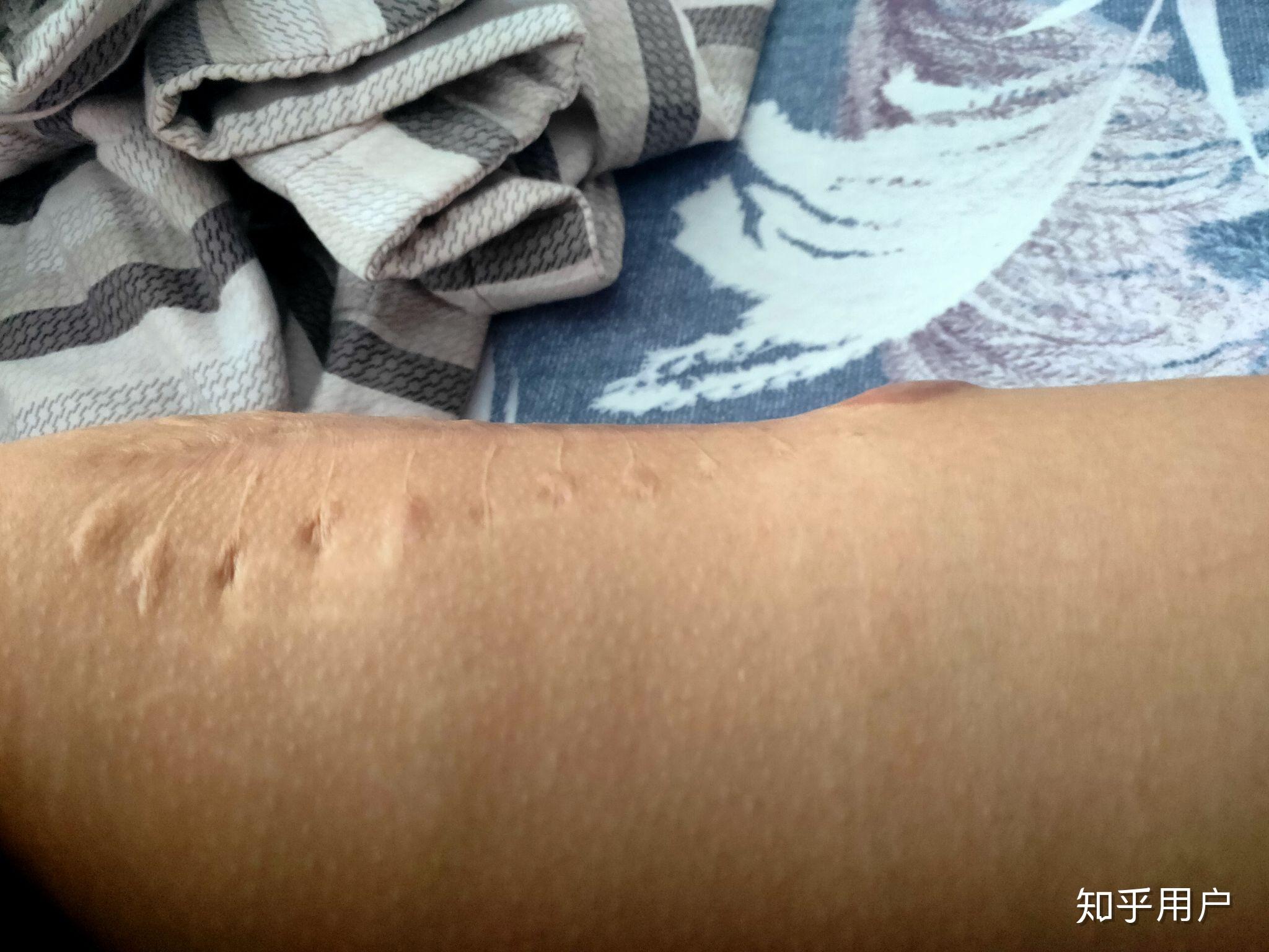 手术疤痕增生后蜈蚣状可以纹身吗