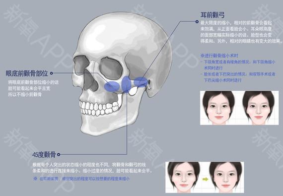 颧骨和颧弓有什么区别 - 知乎