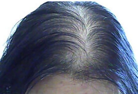 脂溢性皮炎引起的脱发怎么治疗,能治愈吗?