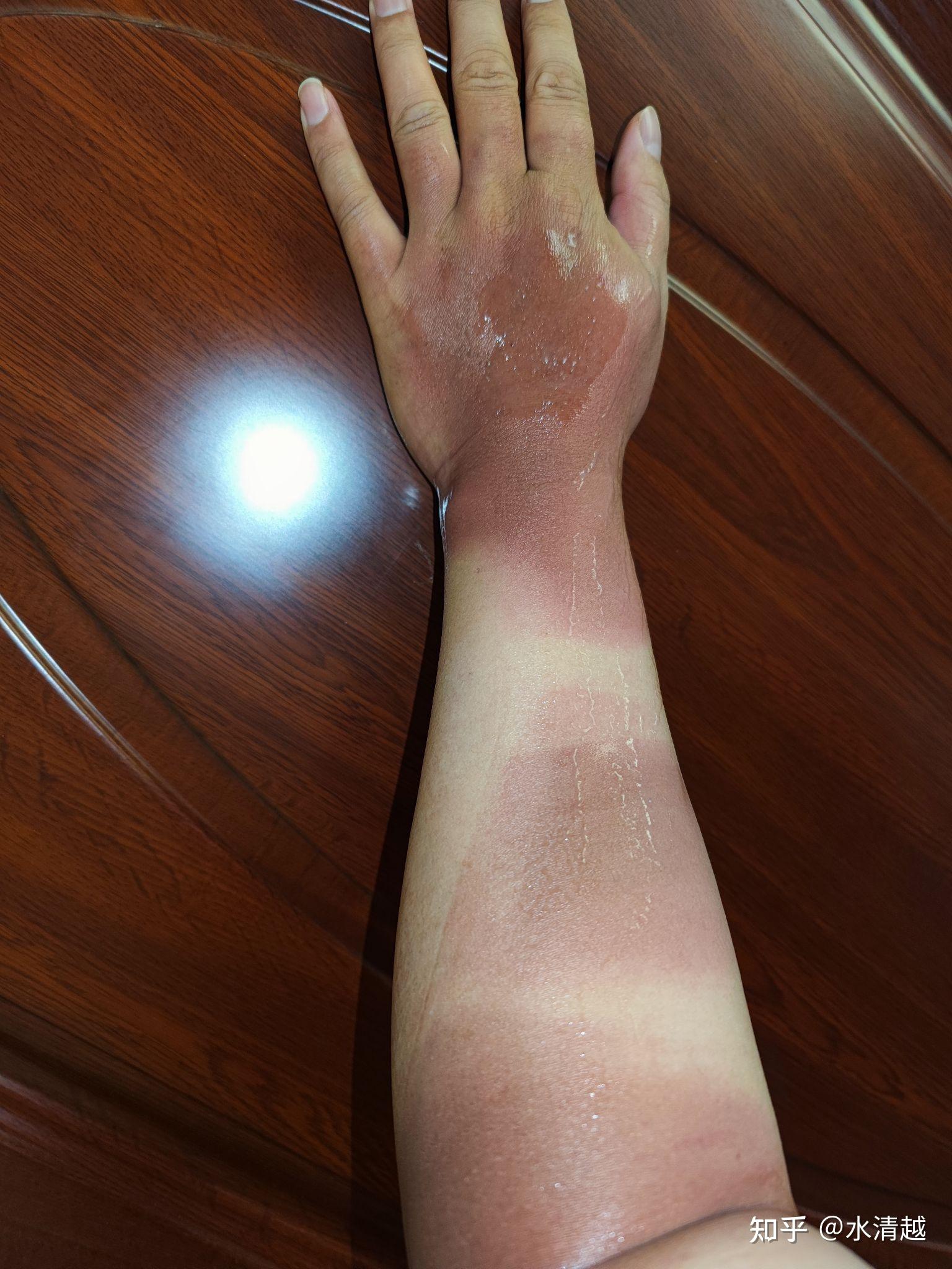 晒伤了啥症状我这样算晒伤吗