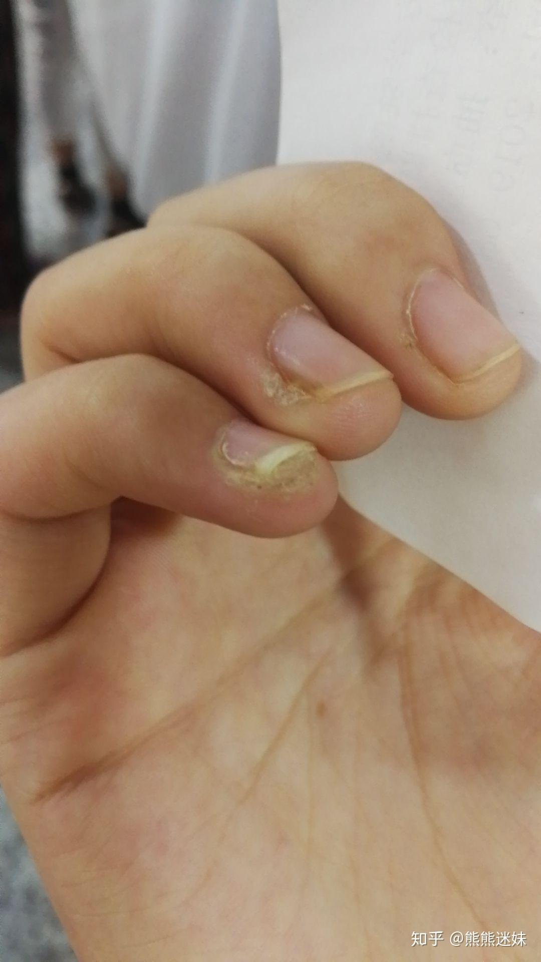 困扰了很多年的甲周疣在右手的中指上疣体已经占据了指甲的一半激光