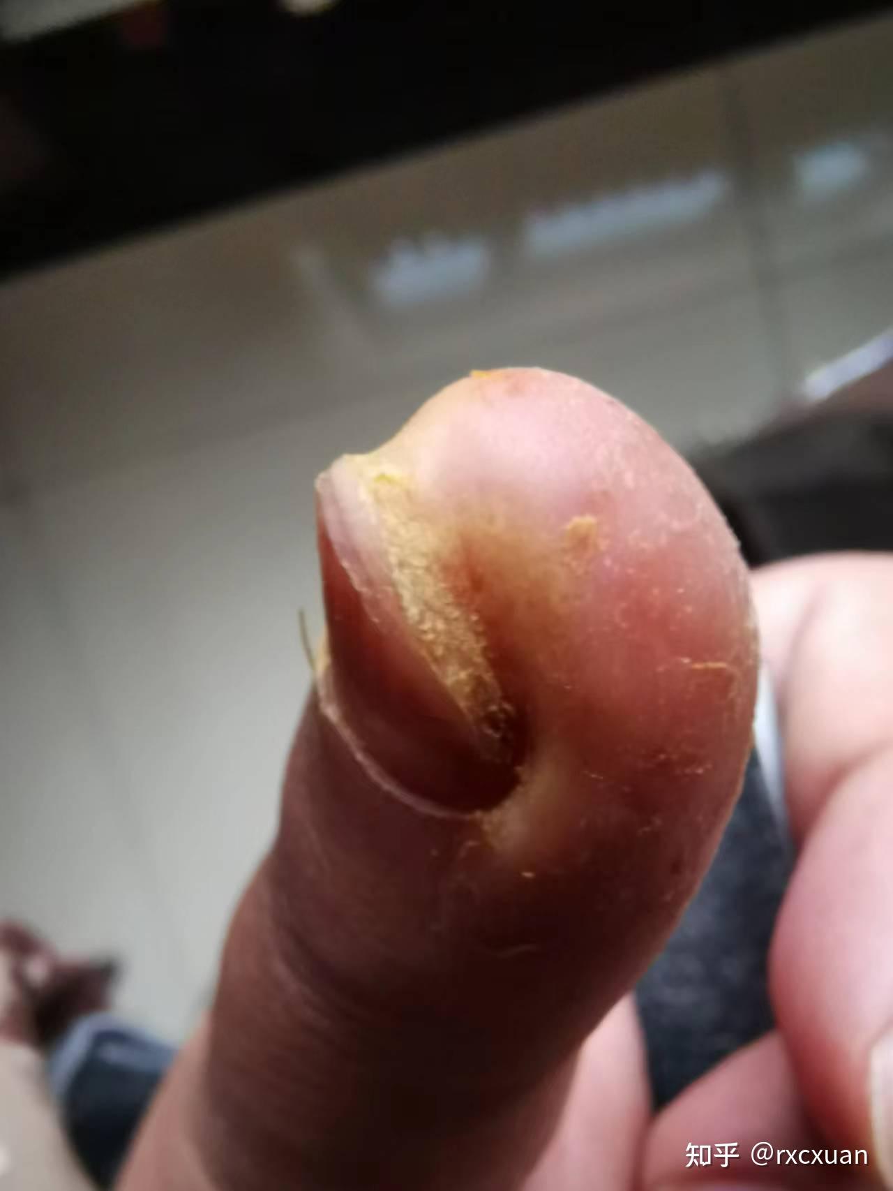 严重的甲周疣还有救么