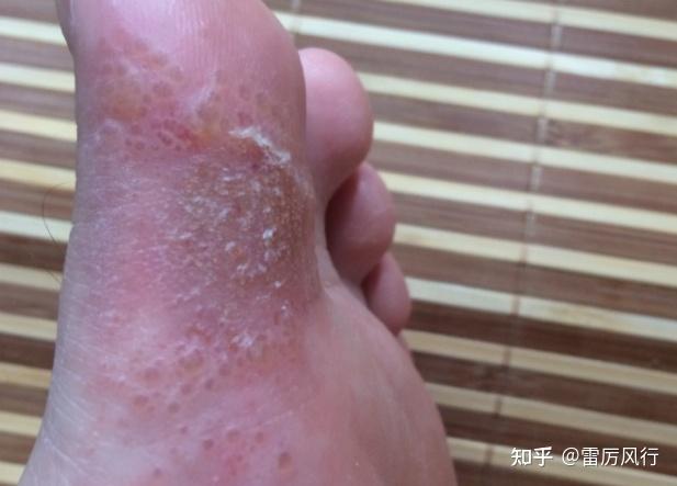 水泡型脚气的水泡需要戳破吗还是用药后会自动消掉呢