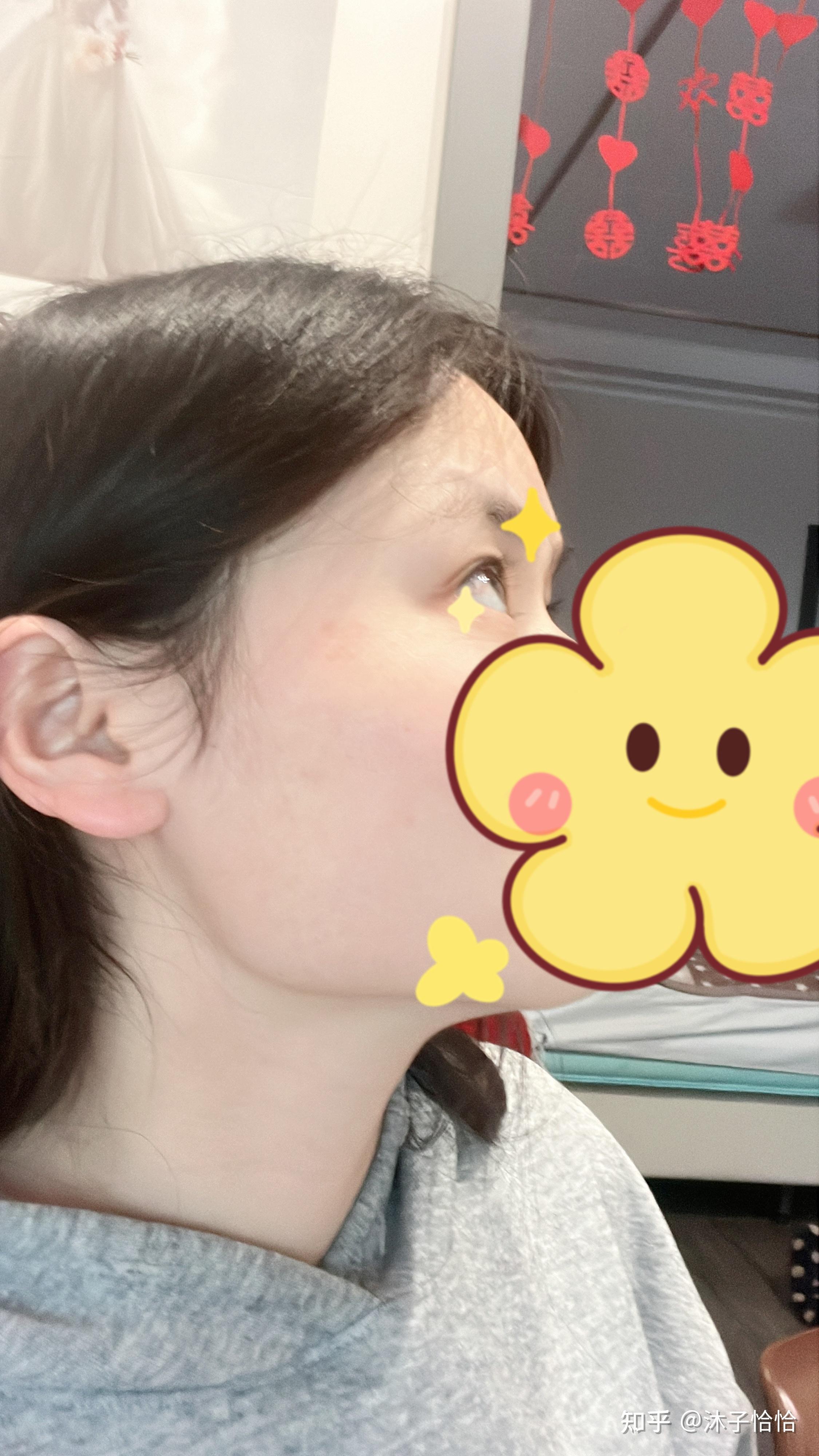 侧颜好难看下颔骨宽怎么办