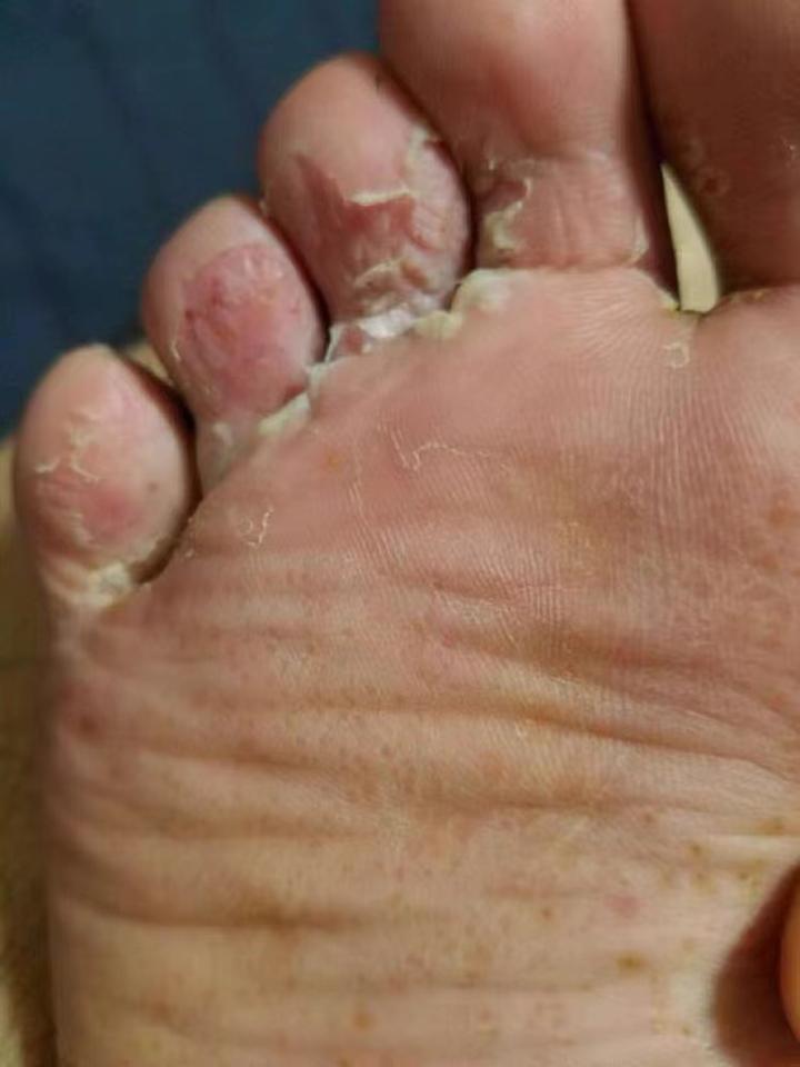 没事的时候可以看看这篇文章,帮你有效解决脚趾缝脱皮发痒疼等问题