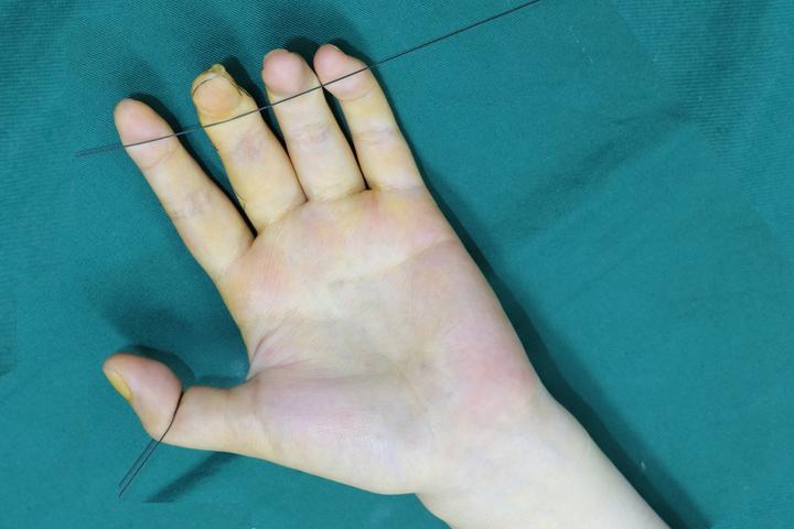 两个拇指并到一起,是多指还是并指?是什么原因造成的? - 知乎