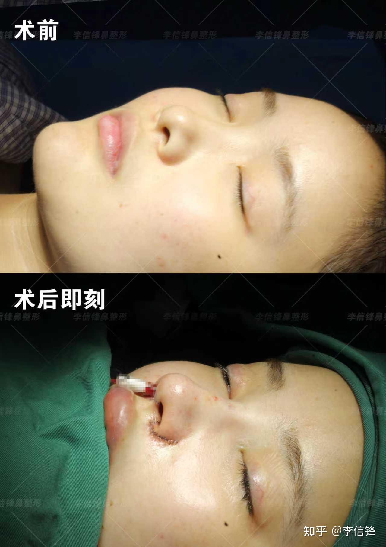 初鼻鼻综合-塌鼻、鼻头圆钝、漏鼻孔,鼻基底凹陷改善,术后即刻对比~ - 知乎