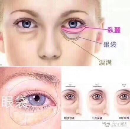 眼袋卧蚕和泪沟有什么区别