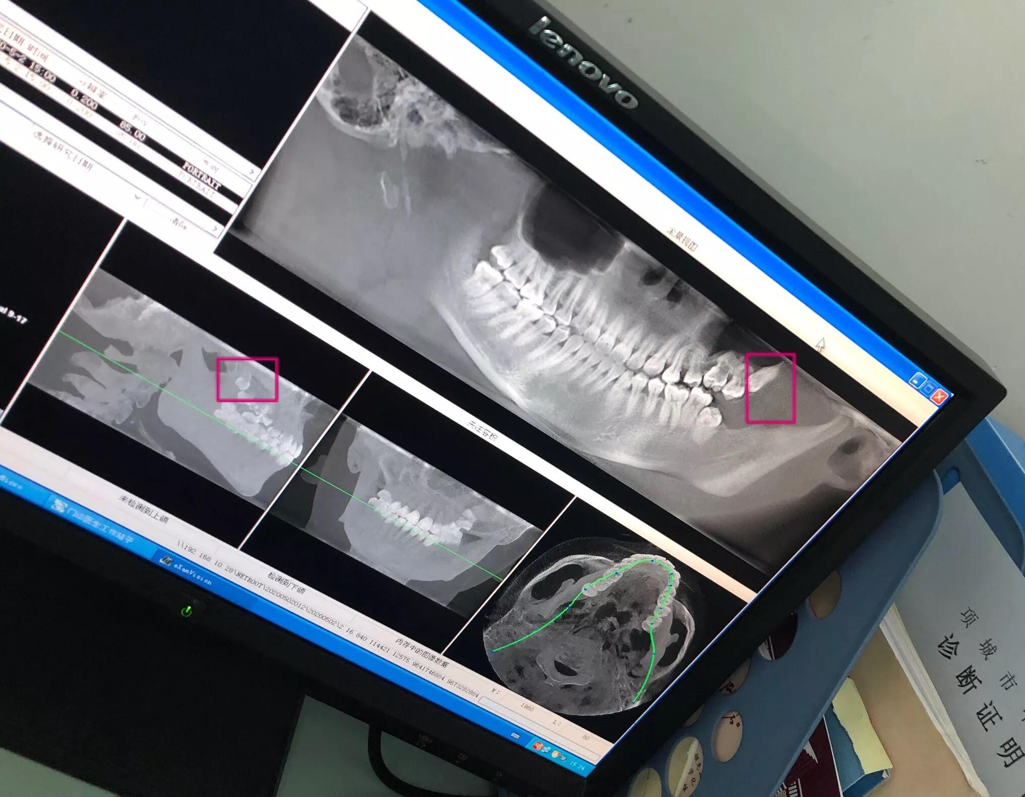 智齿长进上颌窦要拔还是不拔该怎么办