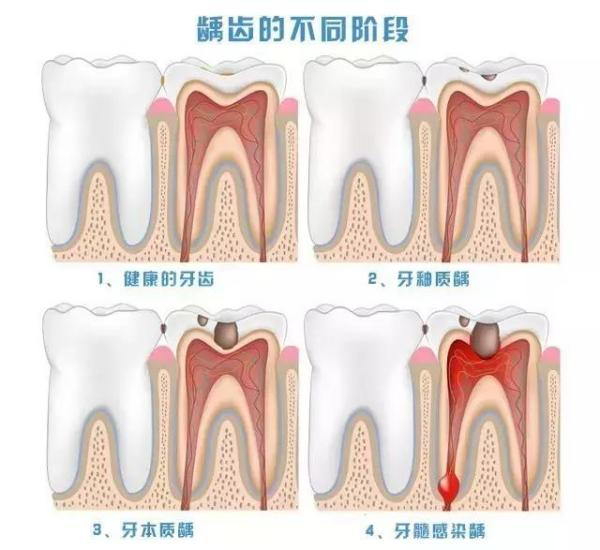 槽牙位置图片