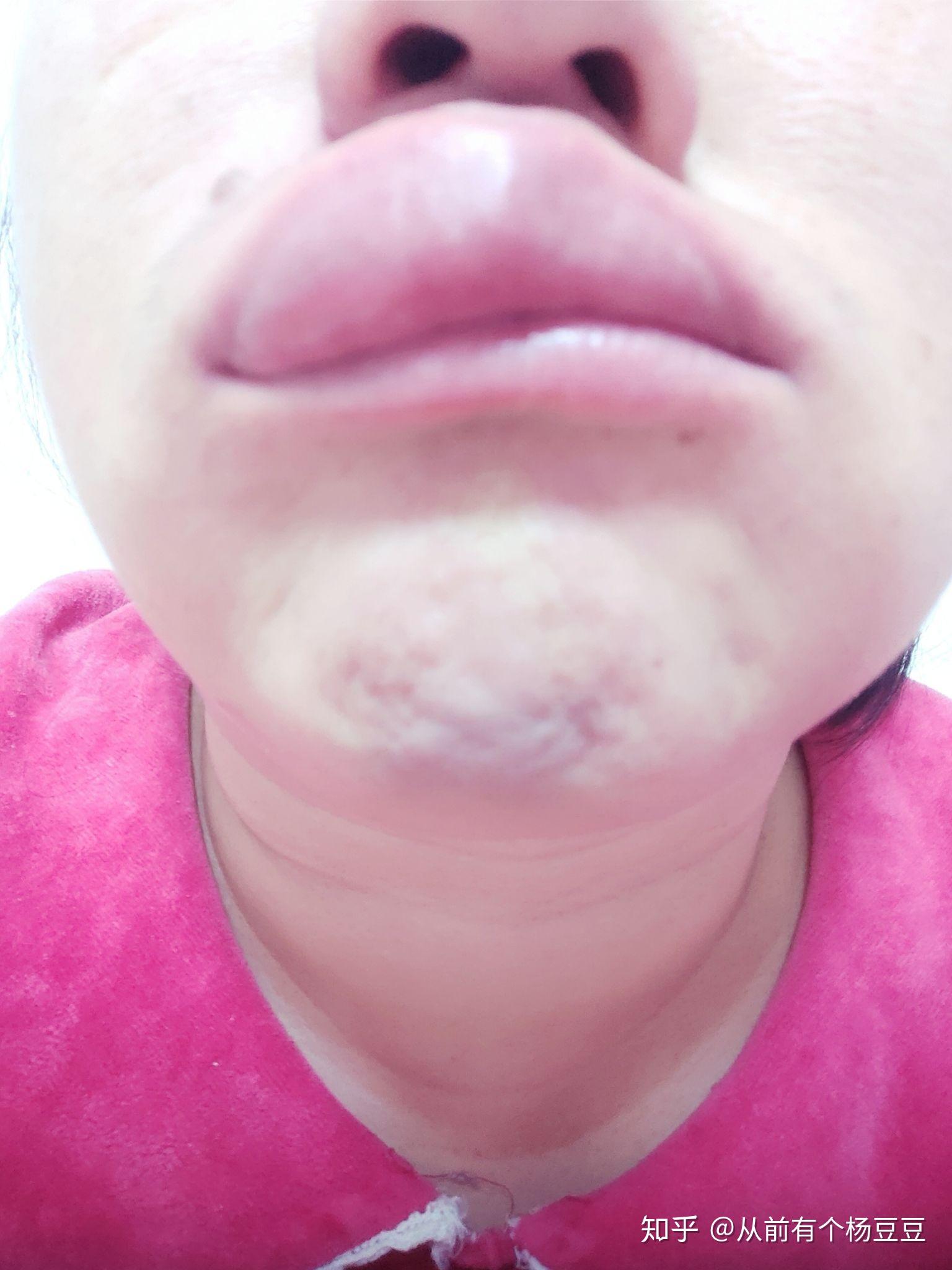 上嘴唇肿了? - 知乎