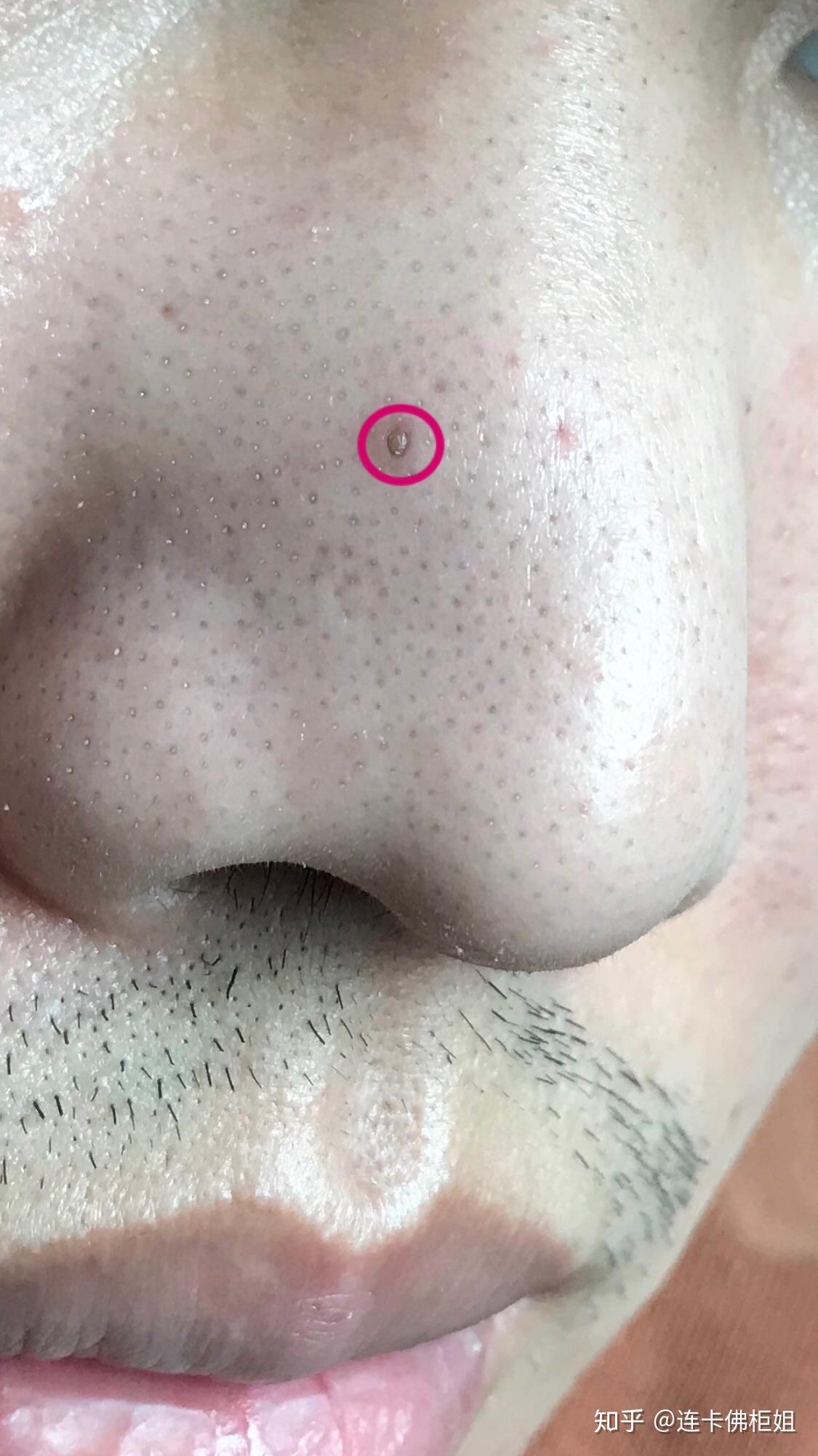 请问鼻子上这种大黑头该怎么处理! - 知乎