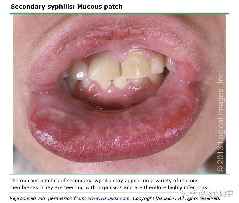 梅毒会通过尿液或则粪便传播吗共用马桶会传播吗