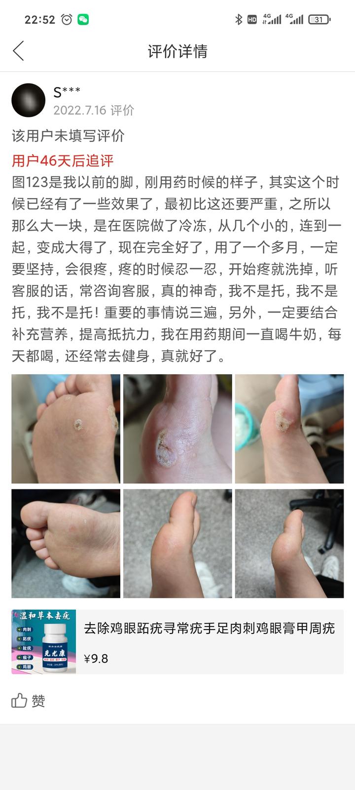 脚上长瘊子怎么治疗图片