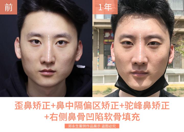 28岁小伙 驼峰鼻 歪鼻矫正手术记录 60天恢复 绝了 知乎 28岁小伙 驼峰鼻 歪鼻矫正手术记录 60天恢复 绝了 知乎