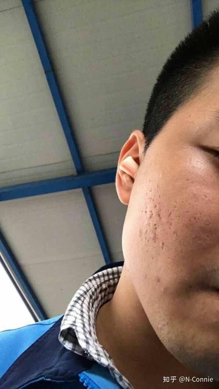 这种类型的痘坑应该如何治疗还有救吗全脸都是痘坑资深麻子脸怎么办呀