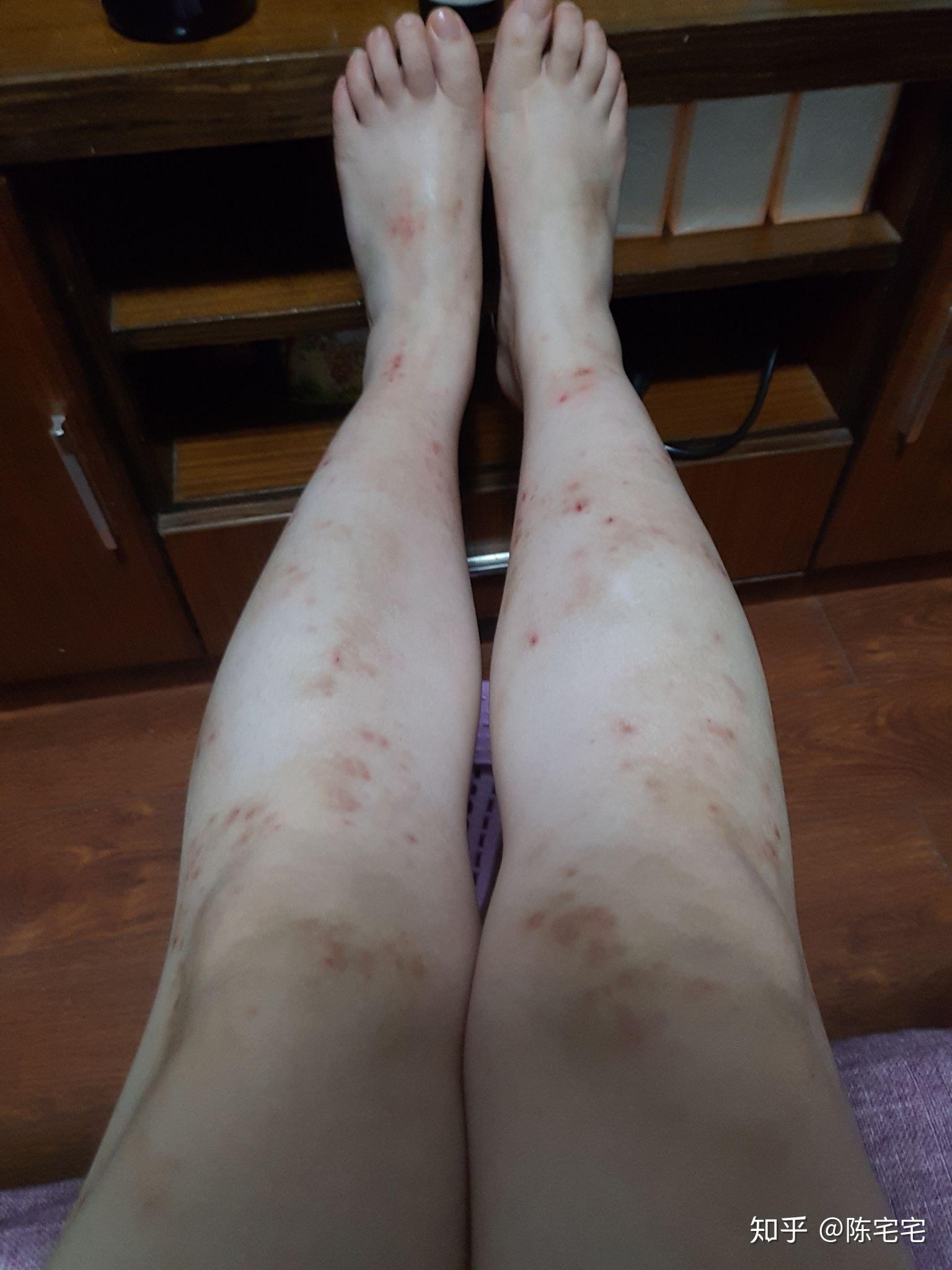 请问这是神经性皮炎还是湿疹太多年了从小到大真的很想穿短裙短裤