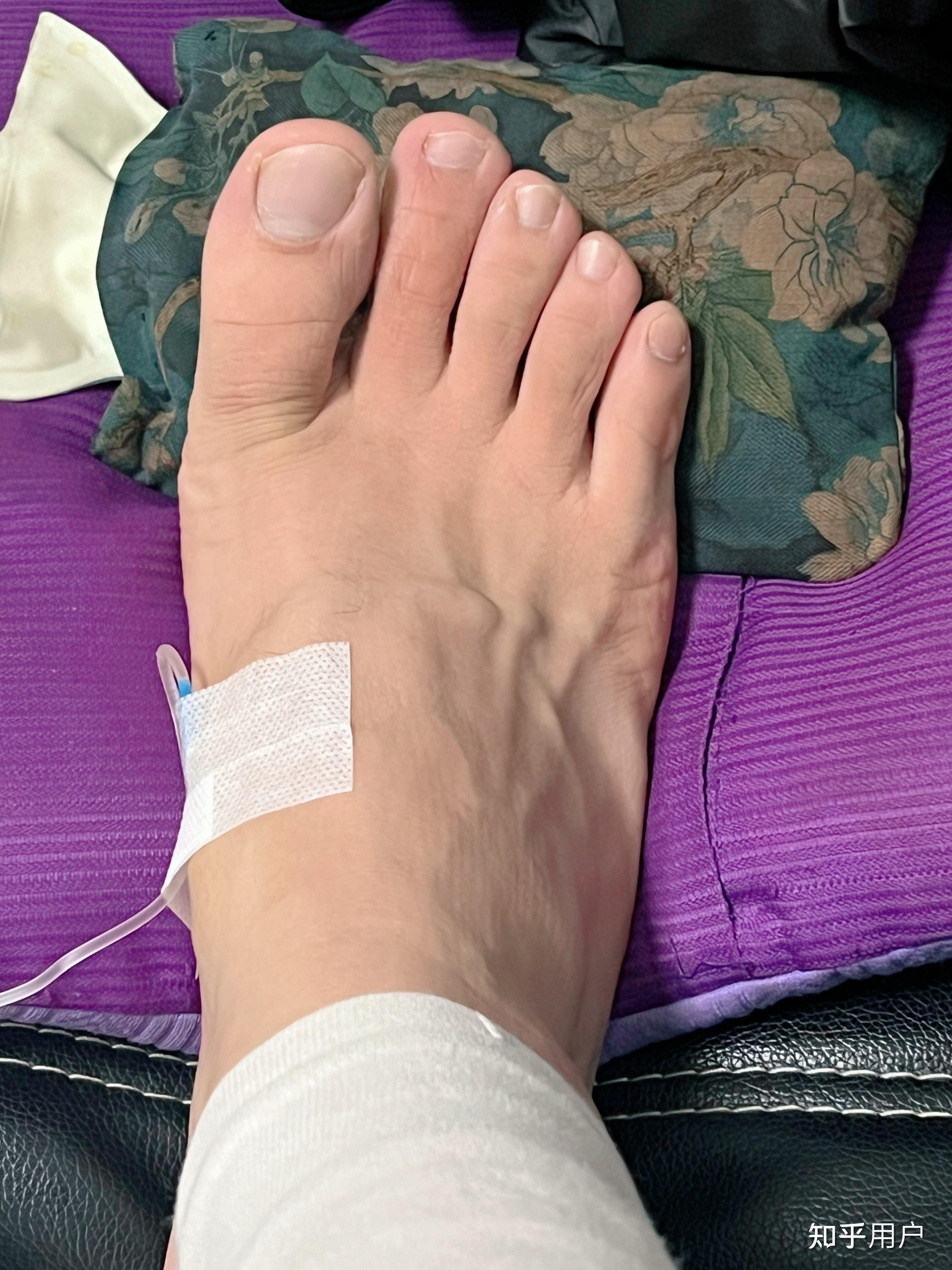 有没有在脚上打针抽血输液的经历