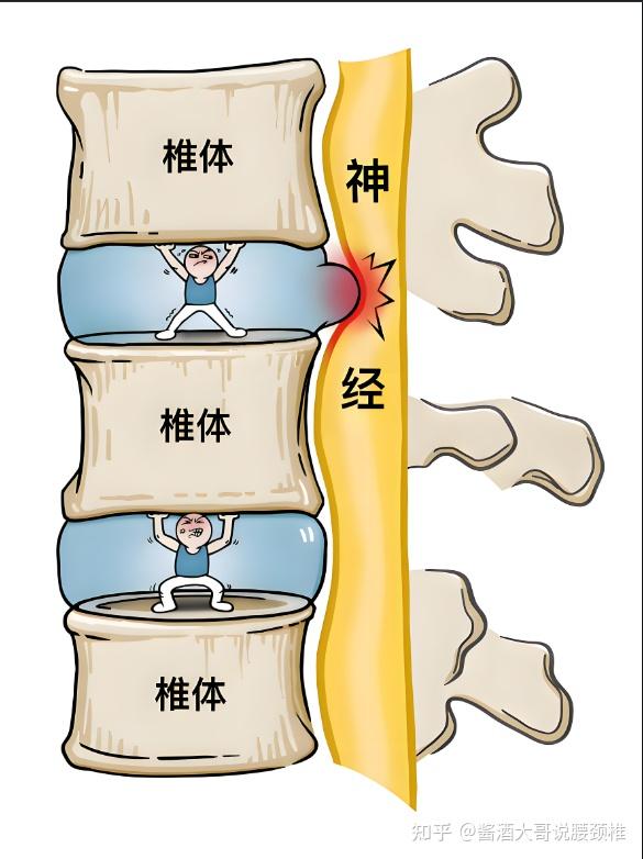 颈椎突出图片 位置图图片