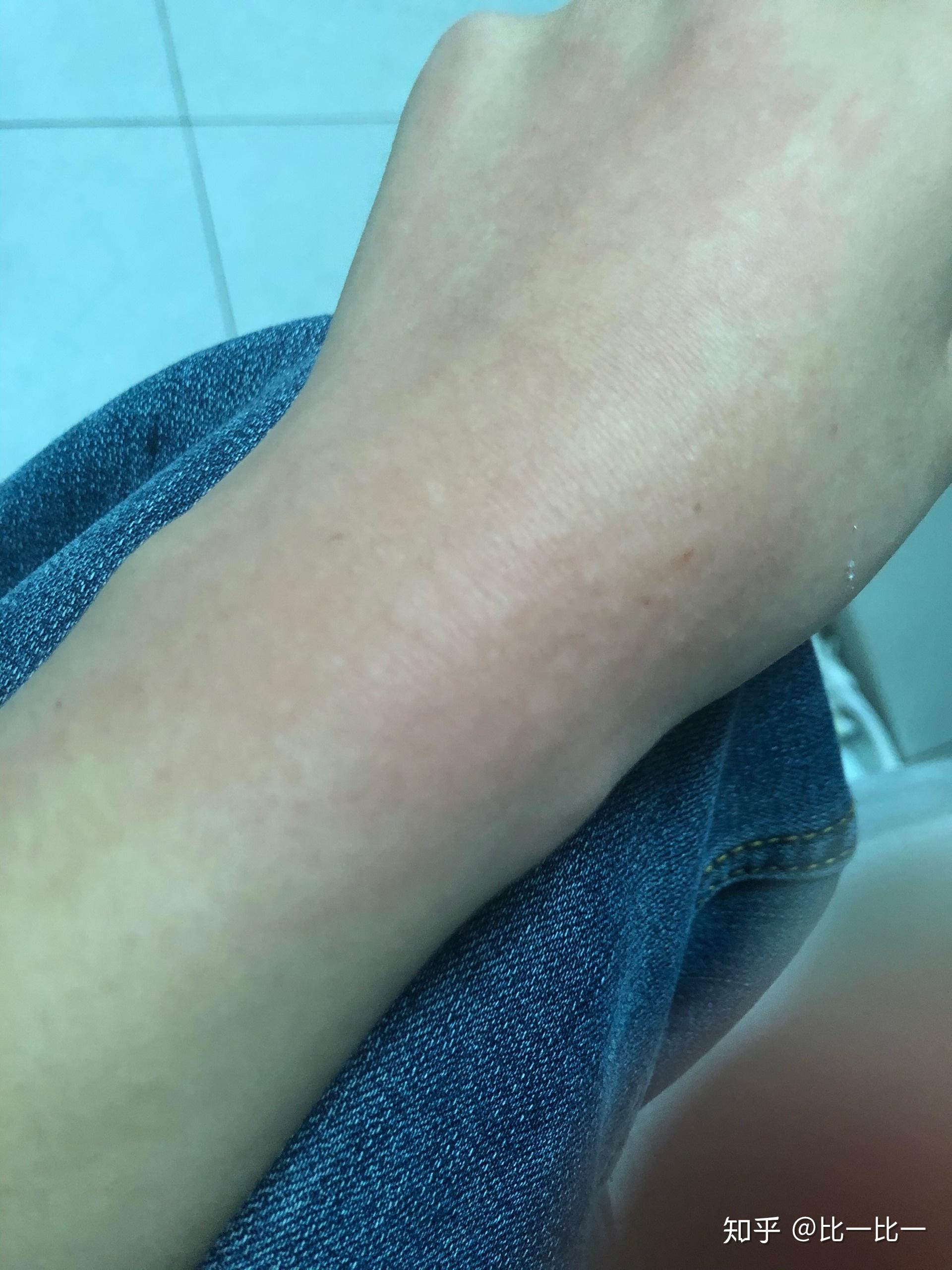 有没有小伙伴和我一样的荨麻疹症状,上图? - 知乎