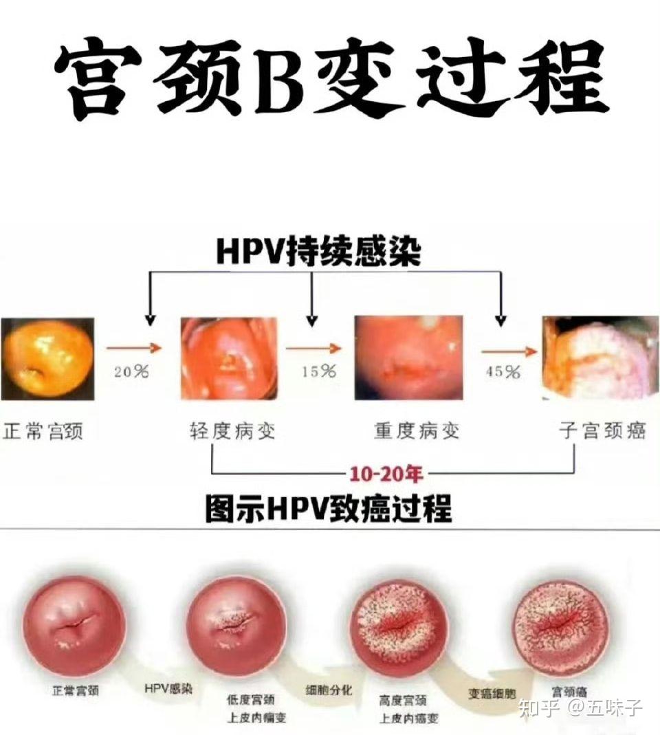 hpv阳性可怕吗