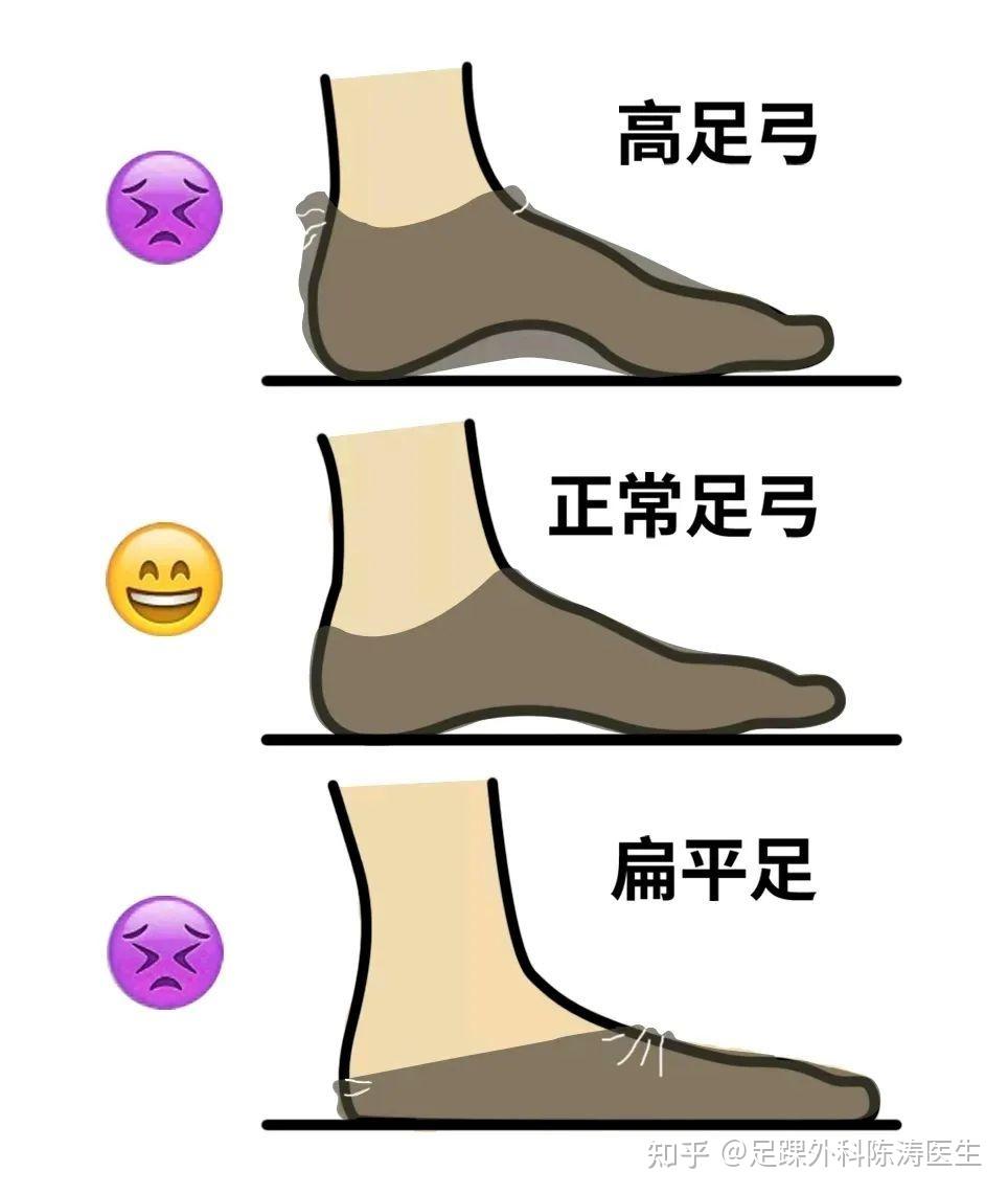 高弓足的人现在怎么样了