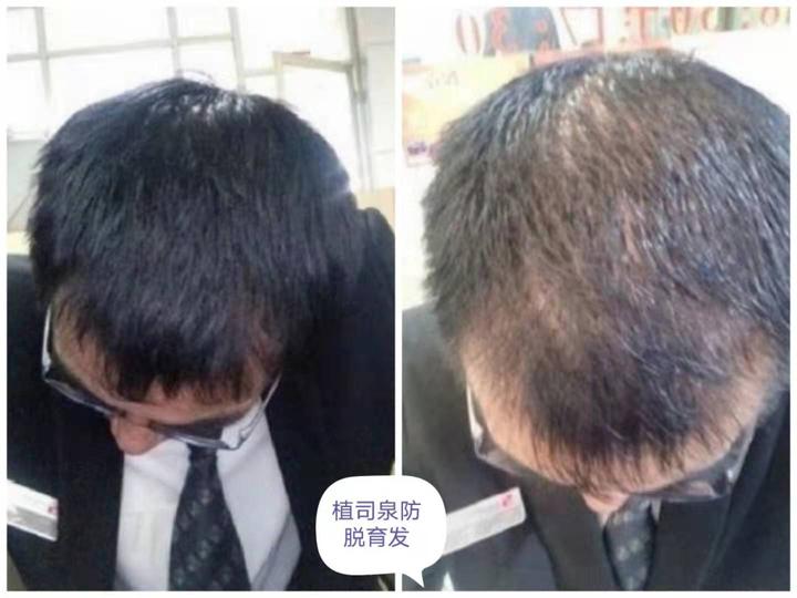 头油,脂溢性脱发,用侧伯叶真的能生发吗 - 知乎
