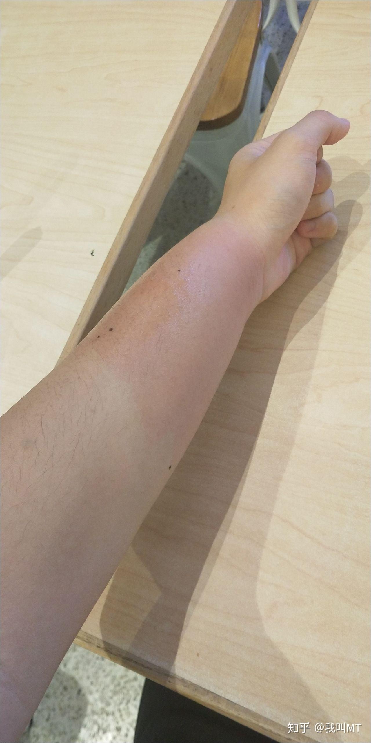 求助你们有被蚊子叮过后整个手或胳膊特别肿大的经历么