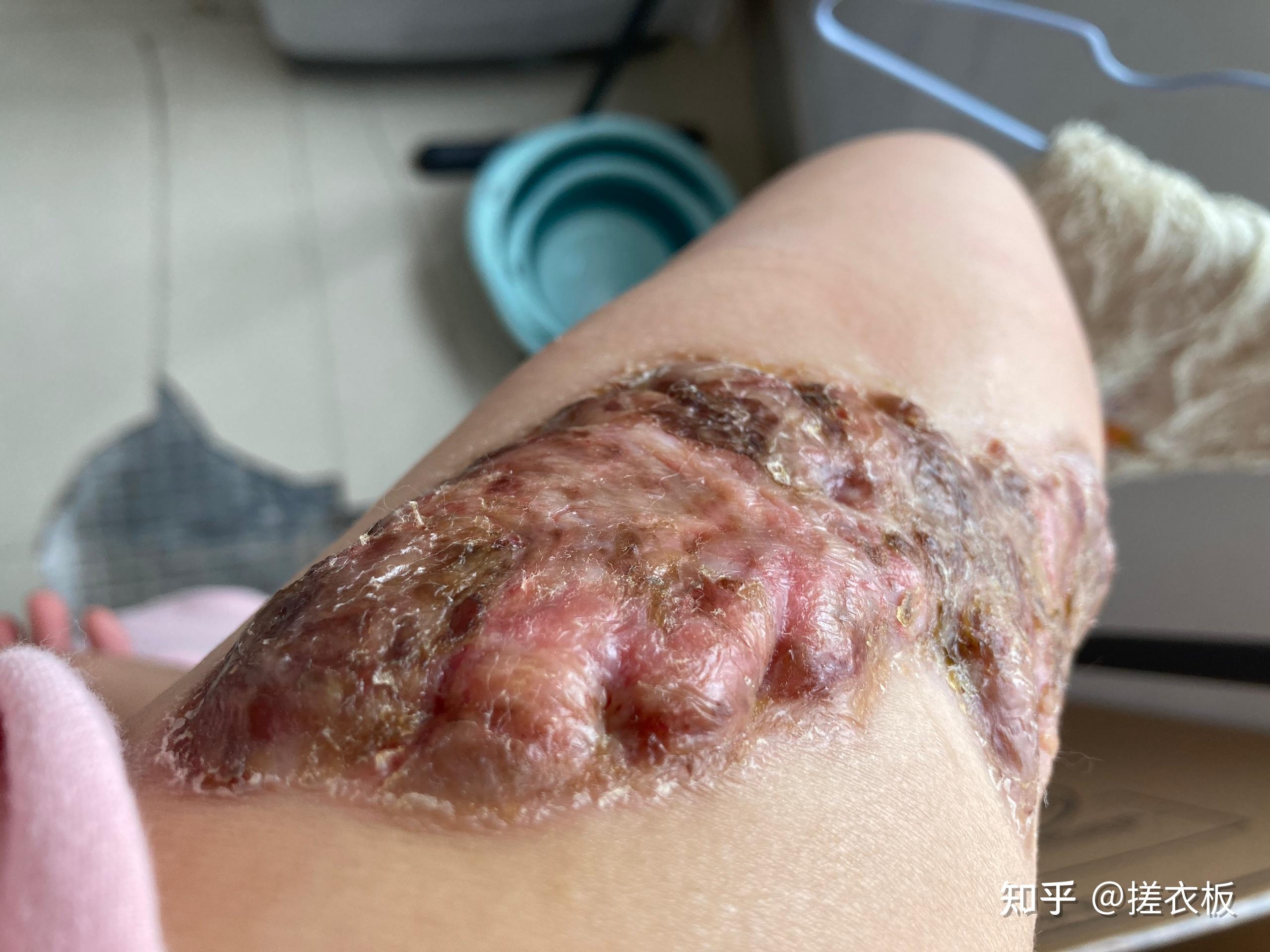 瘢痕体质的人这一生有什么样的体验? - 知乎