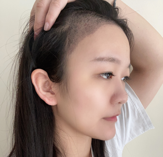 女性植发应注意什么 - 知乎