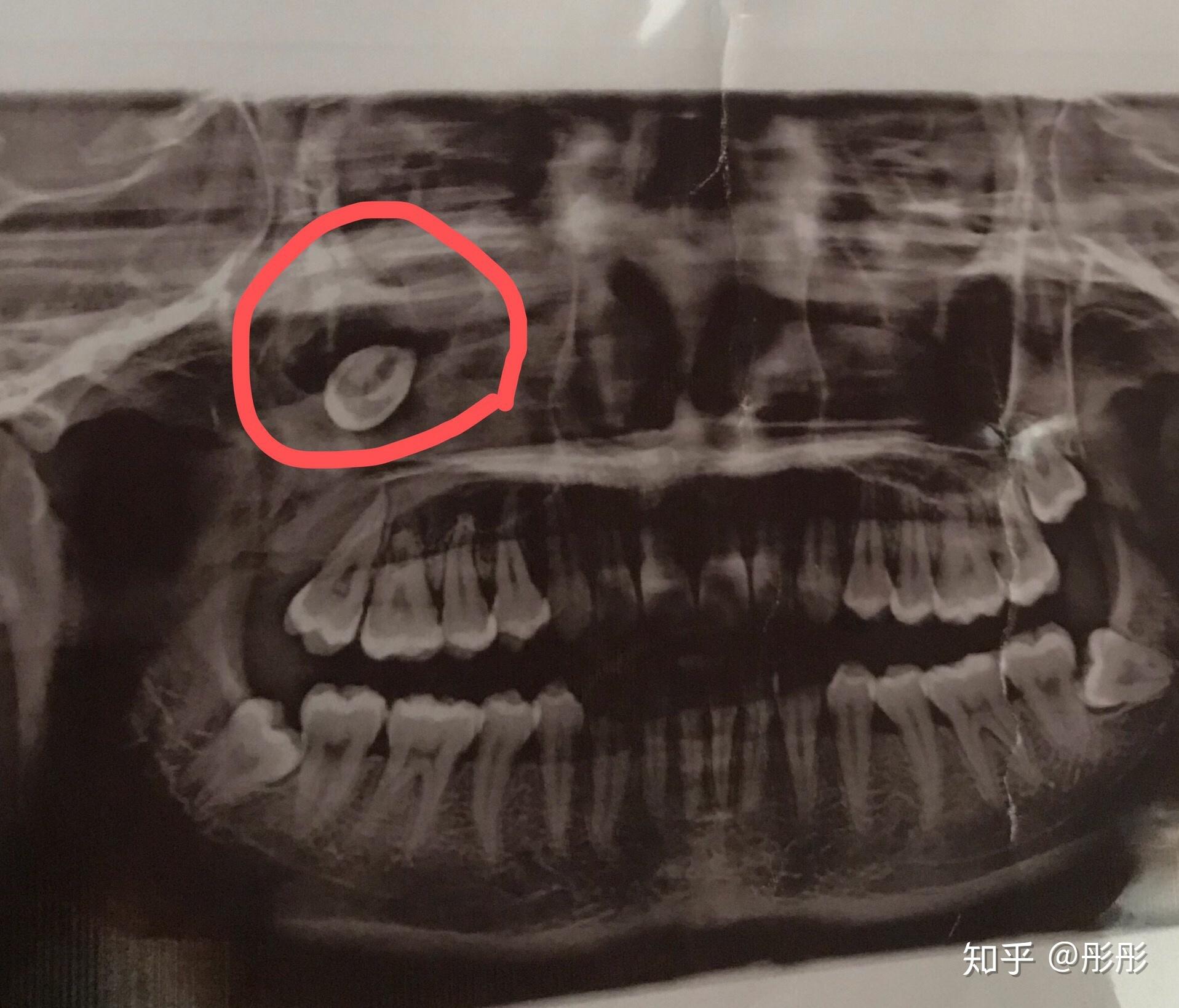 智齿长到上颌窦ct图图片