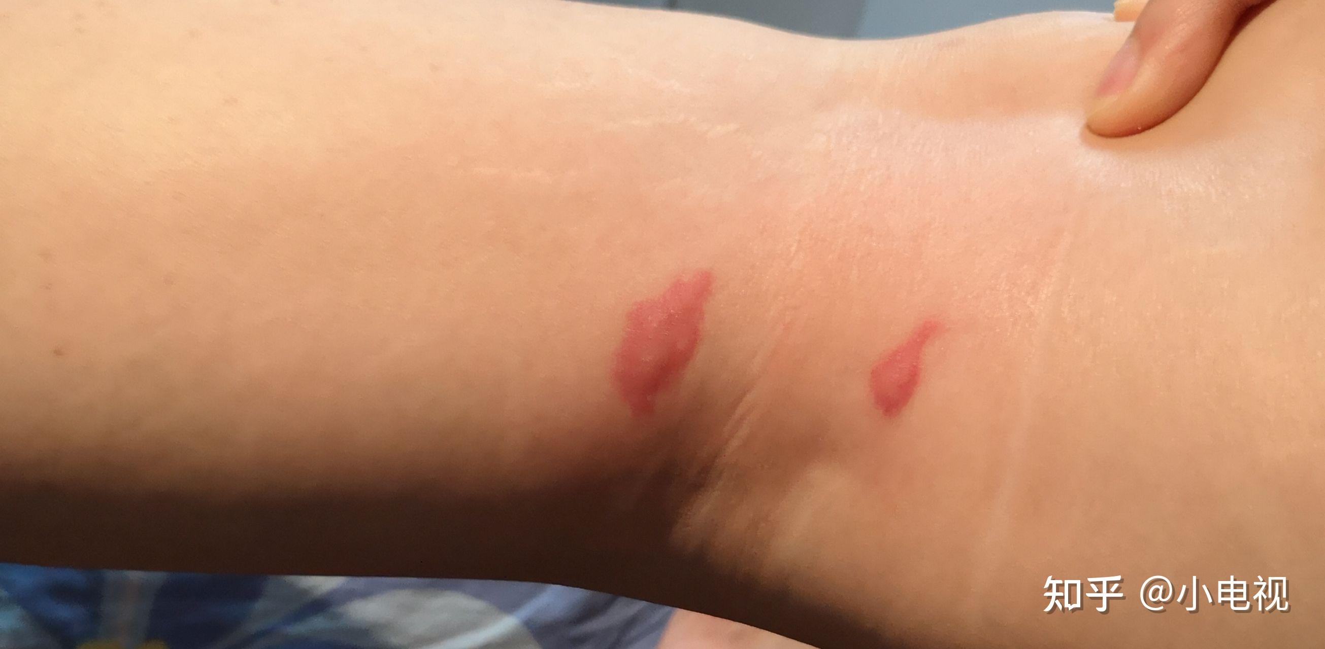 为什么我被蚊子咬了之后皮肤会变成类似淤青的紫红色消退的很慢肿的