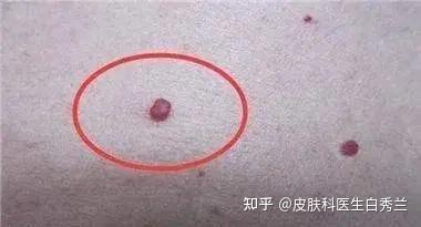 皮肤长血痣,是肝胆在报警了 - 知乎